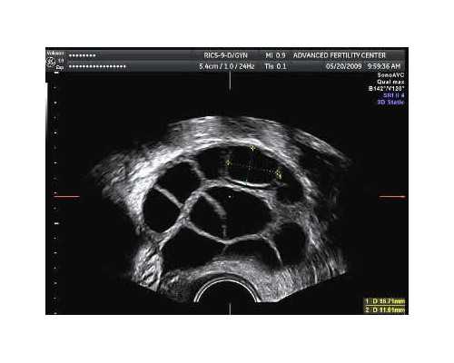 
              怀孕前三个月戴避孕套同房对宝宝有影响吗？
            